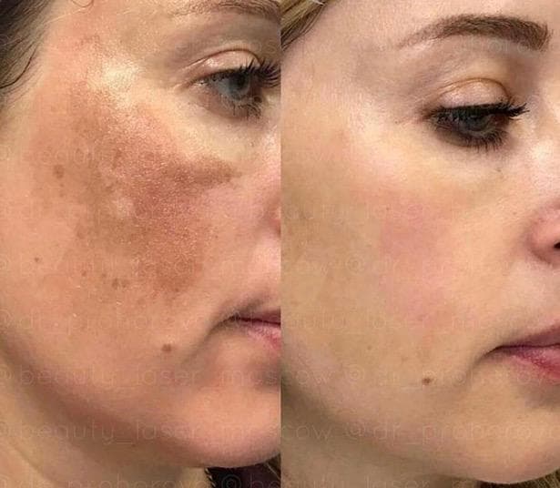 Microchanneling Treatment