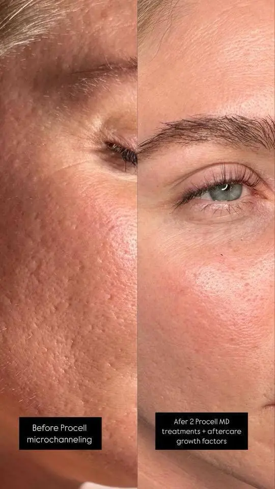Microchanneling + Growth factors